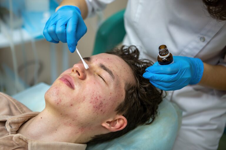 Treatment of acne in adolescents. Facial peeling to fight acne on the face